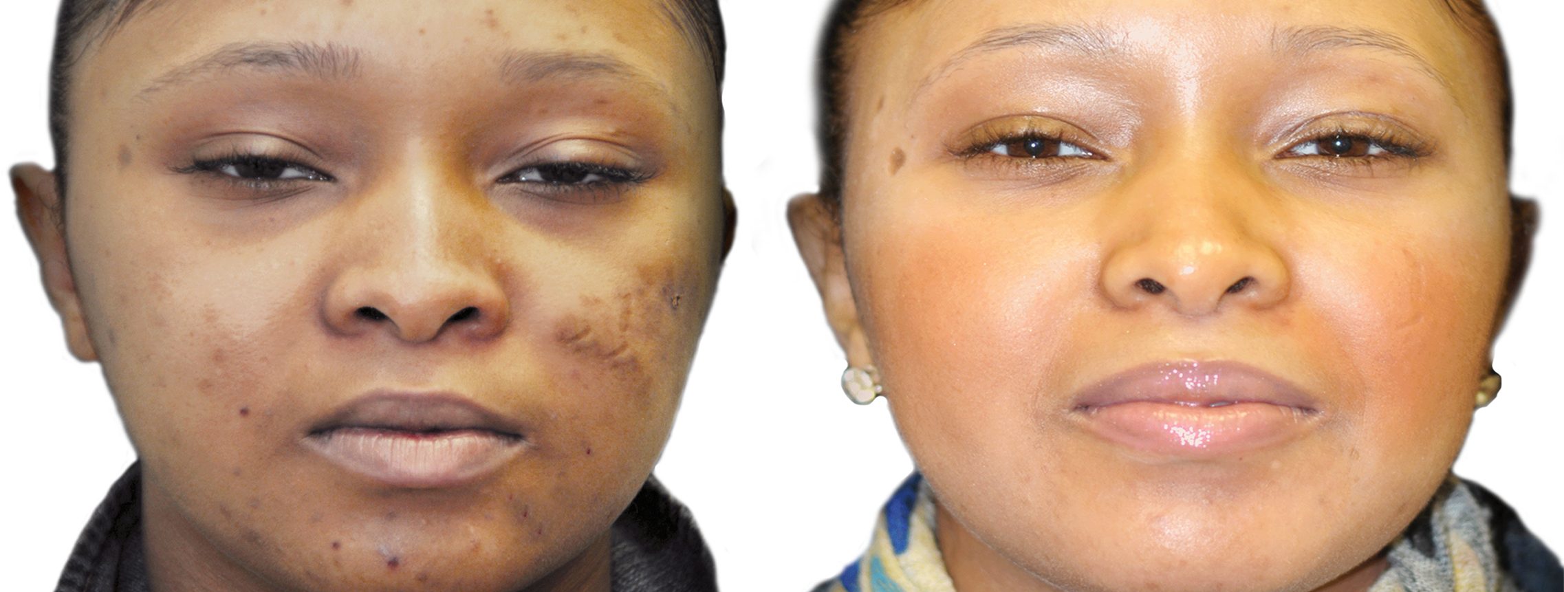 Long Island acne removal before and after