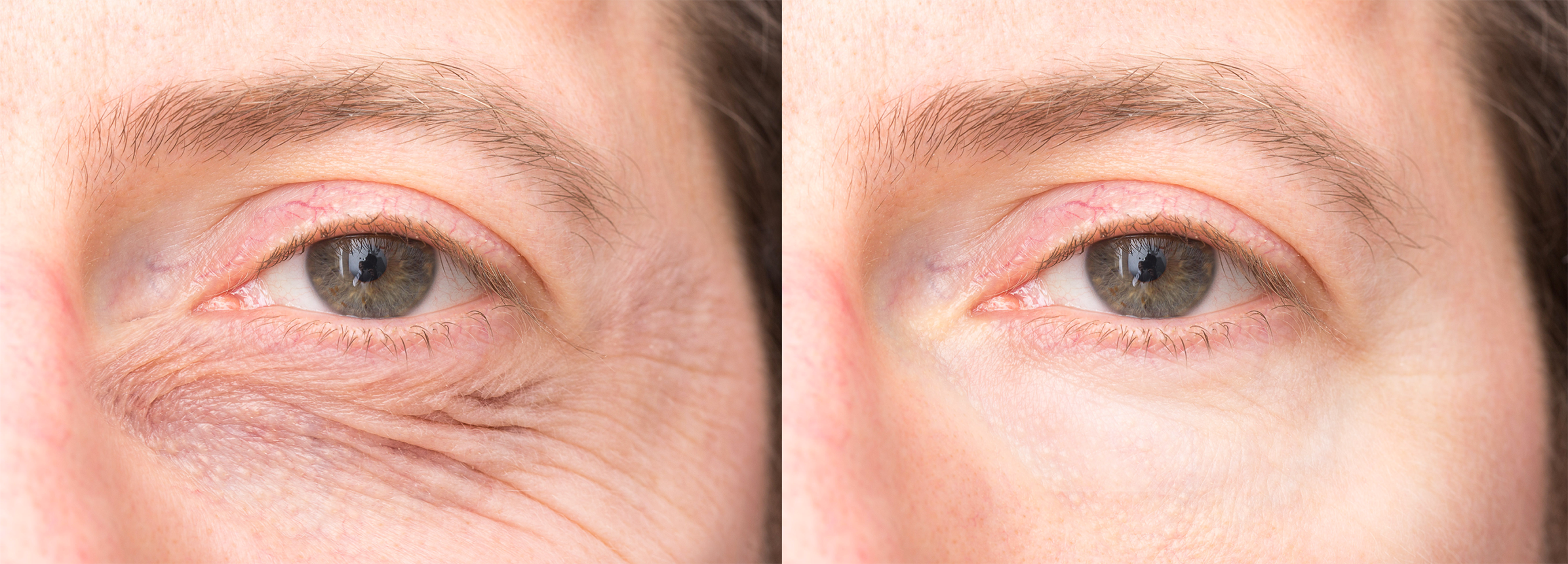 Long Island eyelid lifts before and after
