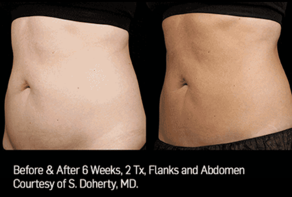 sculpsure_long_island_perfect_body_laser.png