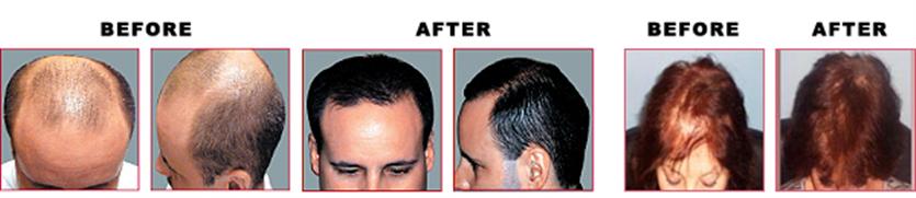 long_island_hair_Restoration_Perfect_body_laser.jpeg