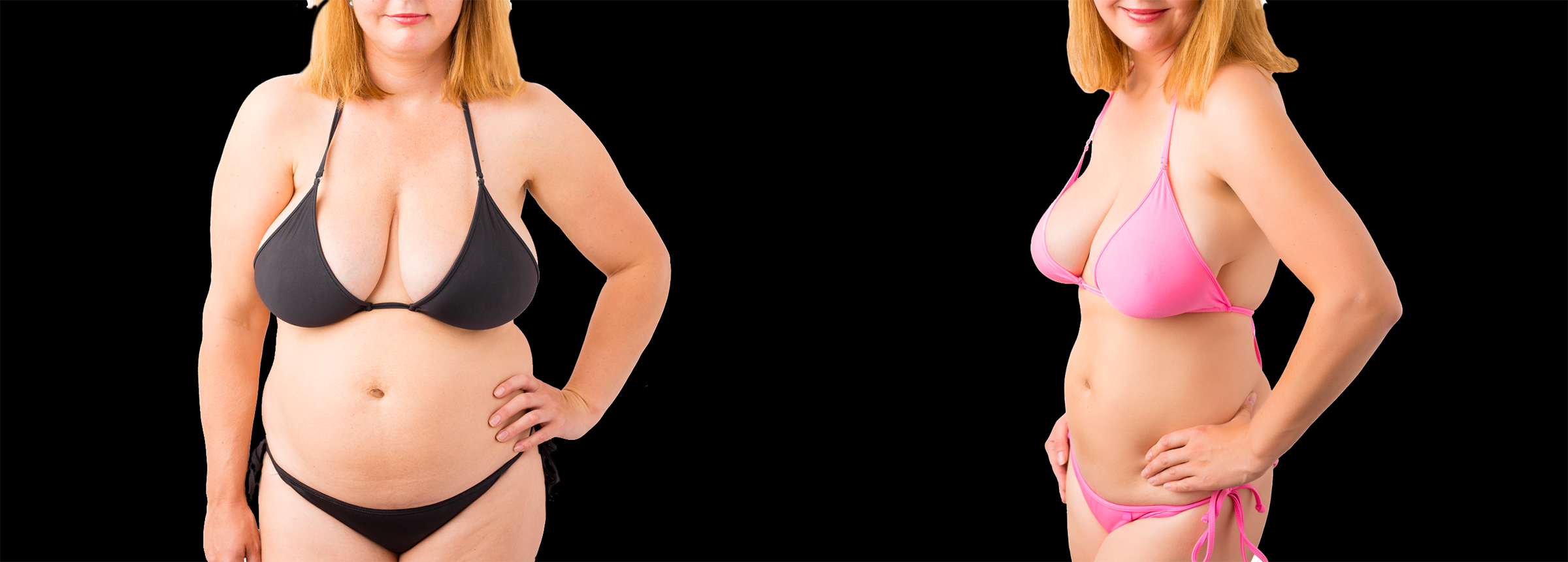 Long Island body reshaping before after