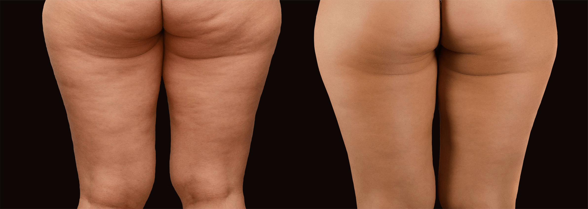 Long Island cellulite removal before after