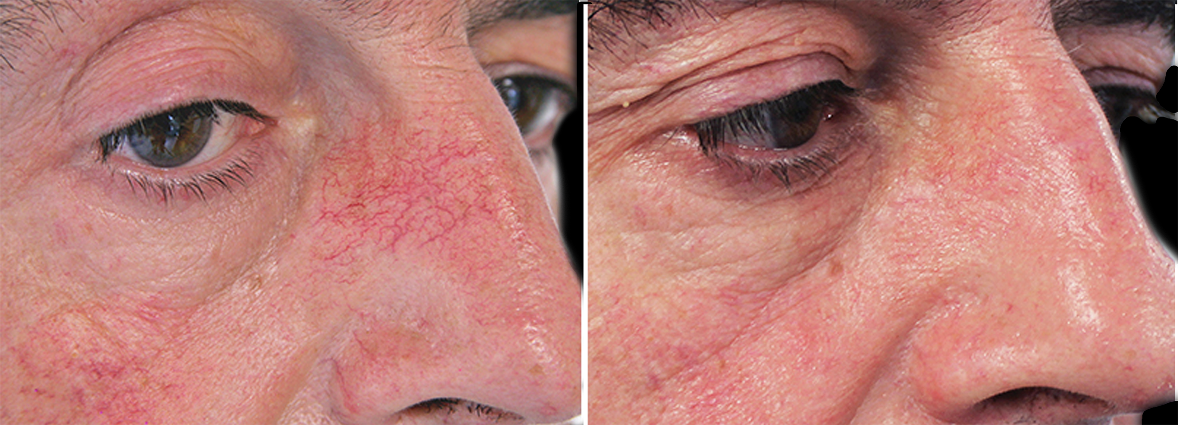 Long Island facial vein removal before after