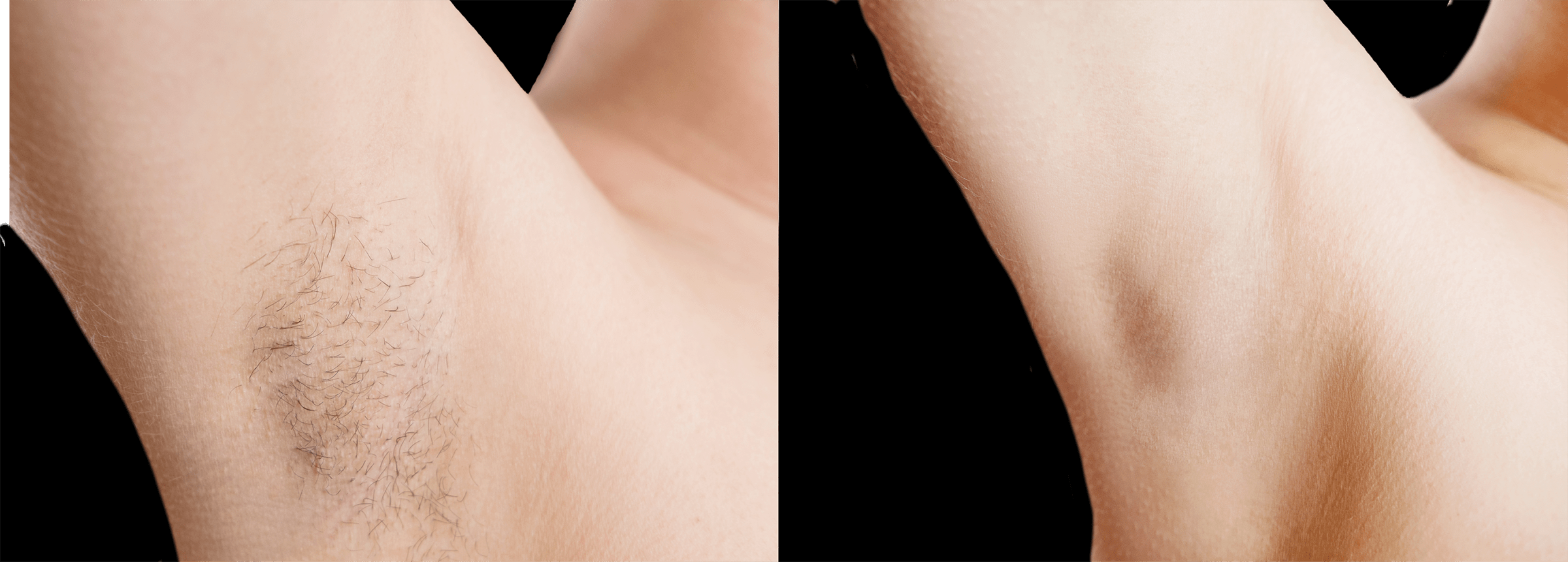 Long Island hair removal before and after