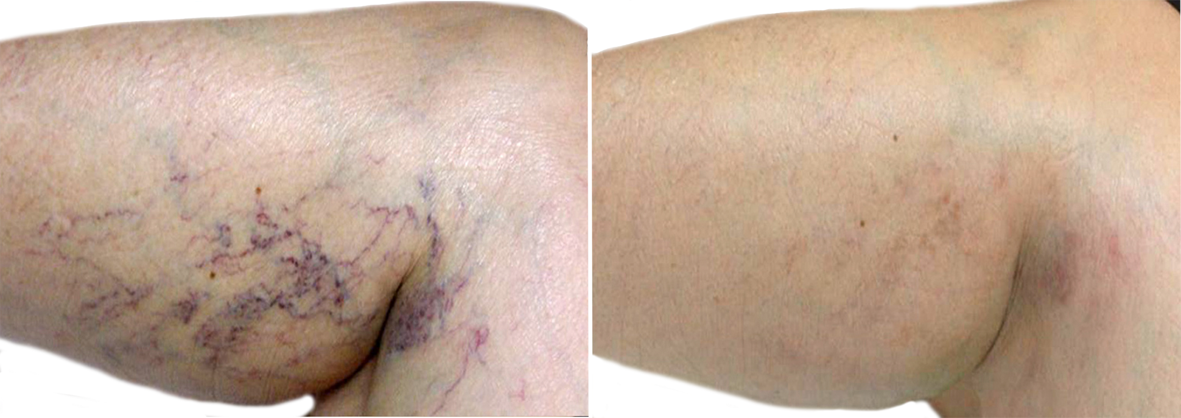 Long Island leg vein removal before after