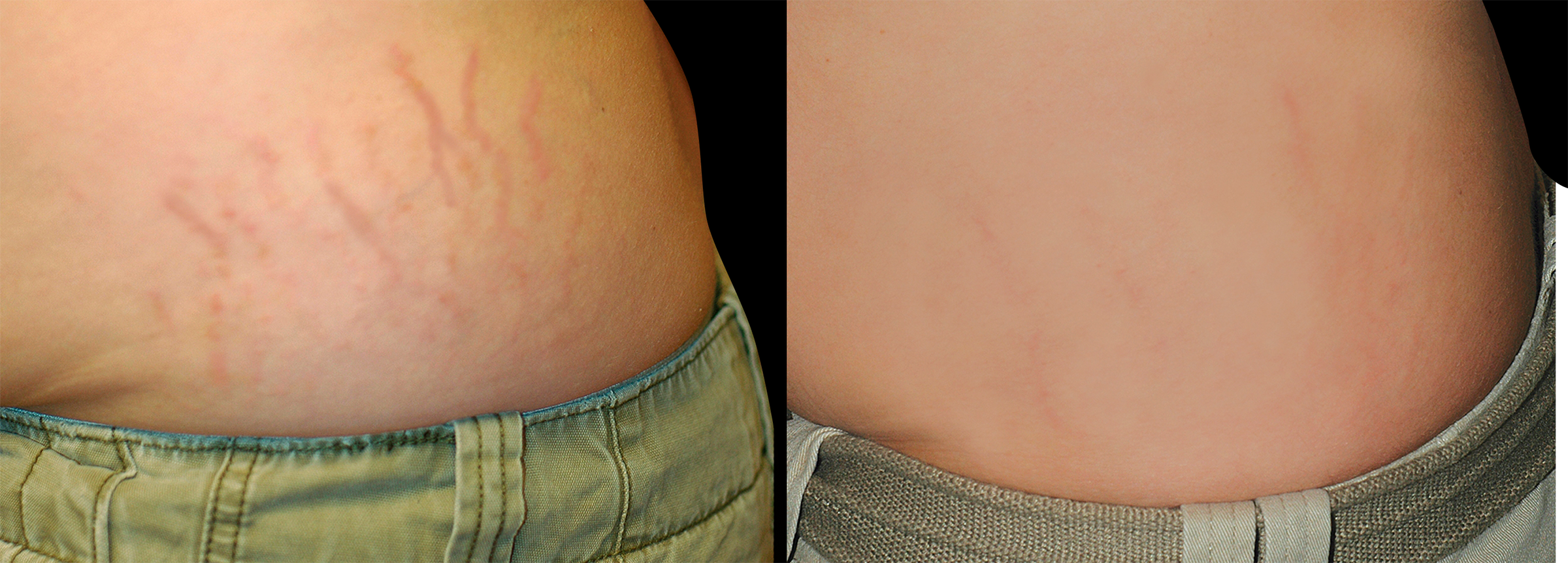 Long Island stretch mark removal before and after
