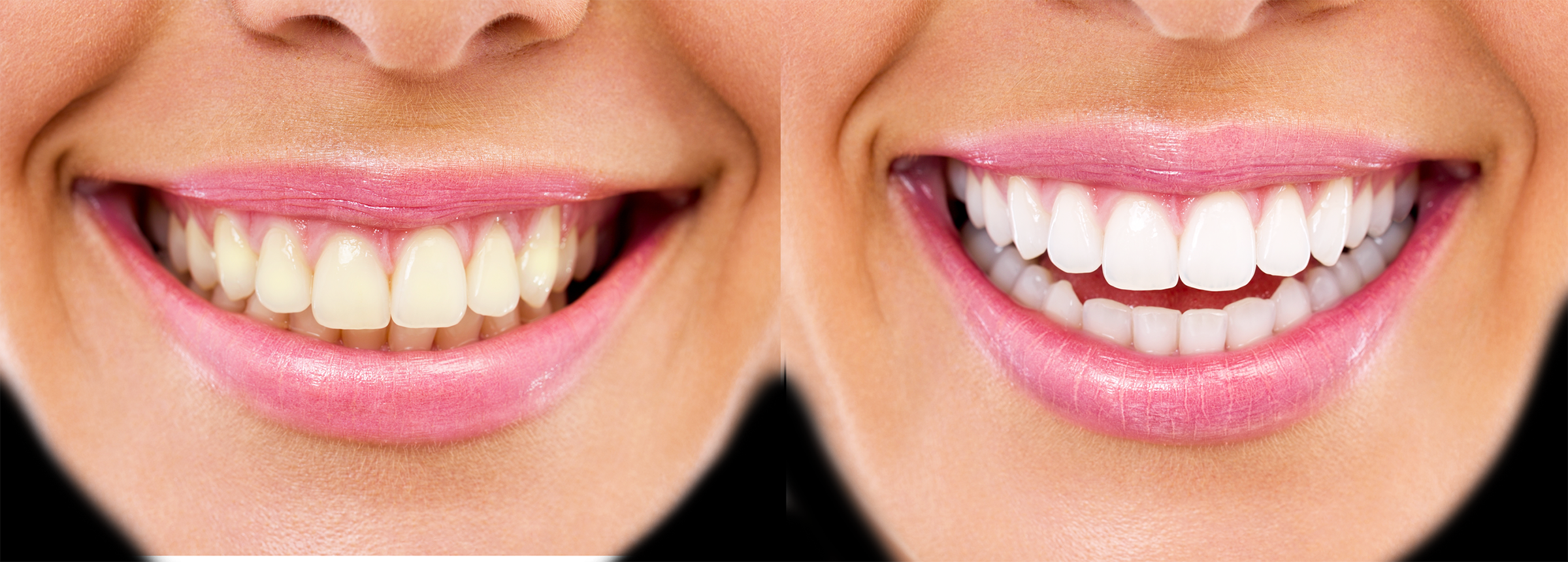 Long Island teeth whitening before and after